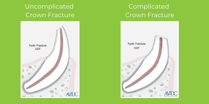 Two visual aids of a complicated crown fracture and an uncomplicated crown fracture. Images from AVDC.